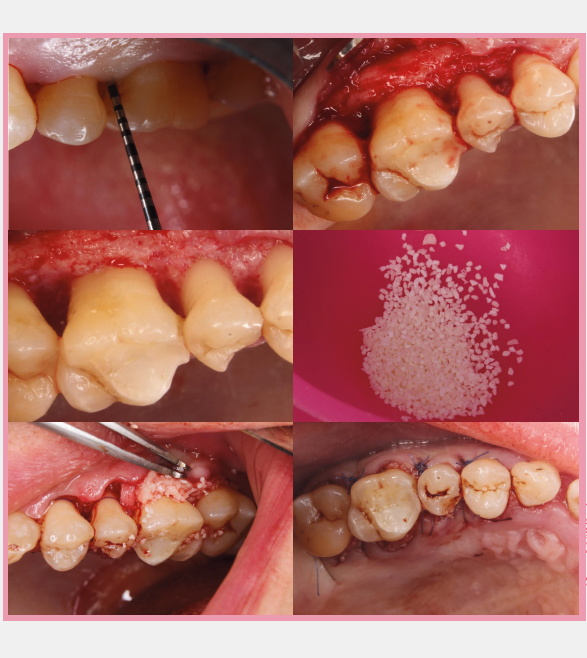 Guided Tissue Regeneration